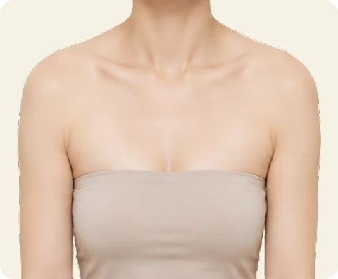 ボディボトックス — illustrative result at 1週目