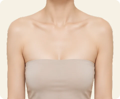 ボディボトックス — illustrative result at 4〜8週間