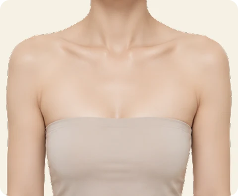 ボディボトックス — illustrative result at 3〜6か月