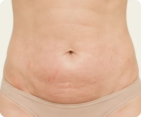 Body Sculptra — illustrative result at Same day