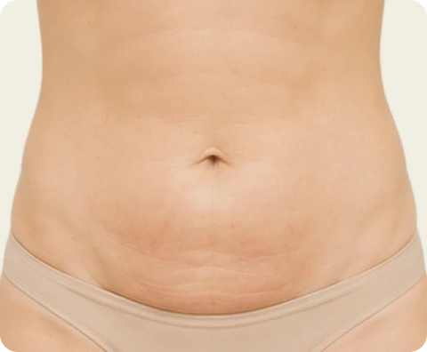 Body Sculptra — illustrative result at 1 week