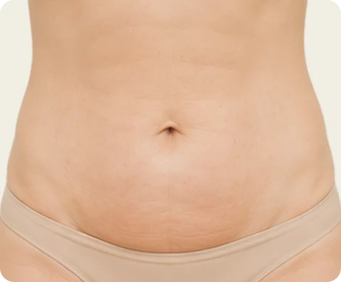 Body Sculptra — illustrative result at 6–8 weeks