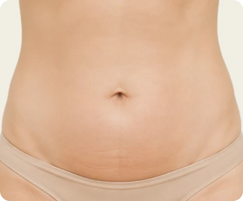 Body Sculptra — illustrative result at 3–6 months
