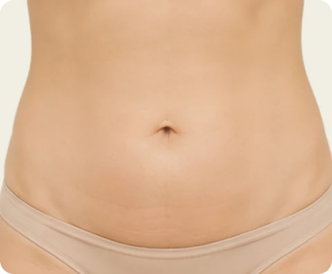 Body Sculptra — illustrative result at Up to 2 years