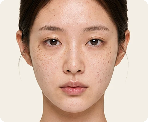 Ultherapy Prime — illustrative result at 当日(Day 0)