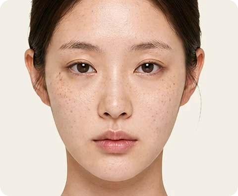 Ultherapy Prime — illustrative result at 1〜3日