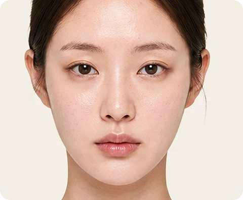 Ultherapy Prime — illustrative result at コース終了時(肌)