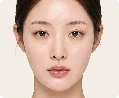 Ultherapy Prime — illustrative result at 頭皮(AGA)