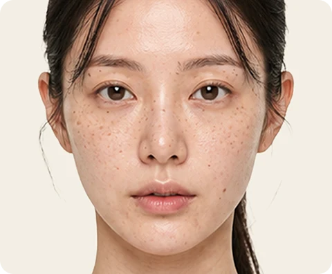 Ultherapy Prime — illustrative result at Ngày 0