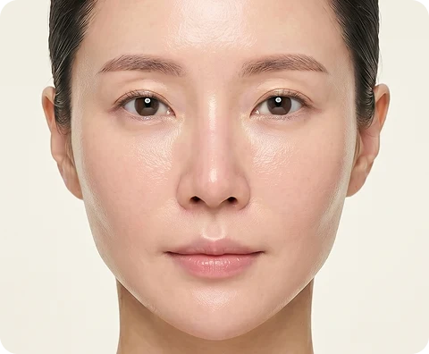 HA フィラー — illustrative result at 1か月目