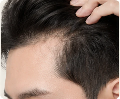 Hair Loss Treatment — illustrative result at Month 1