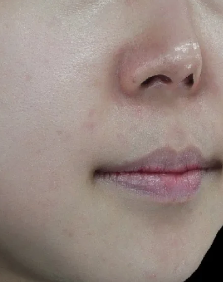 Pico Laser — after