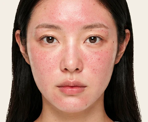 Potenza — illustrative result at 施術直後