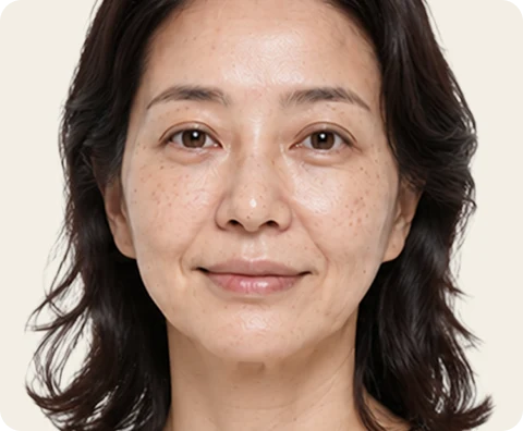 Ultherapy Prime — illustrative result at اليوم 0