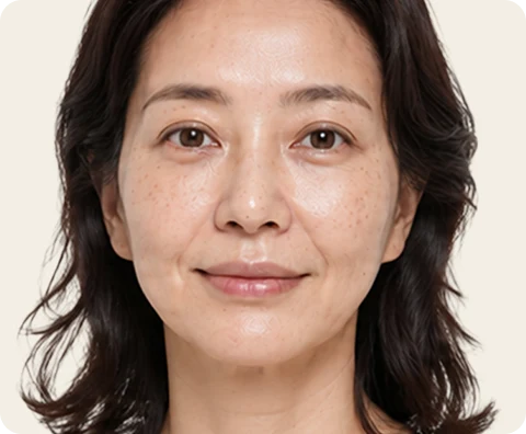 Ultherapy Prime — illustrative result at اليوم 1–3
