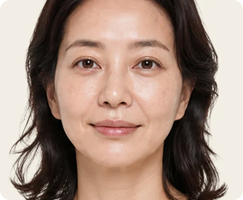 Ultherapy Prime — illustrative result at الأسبوع 2–4