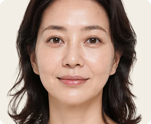 Ultherapy Prime — illustrative result at الشهر 3–12