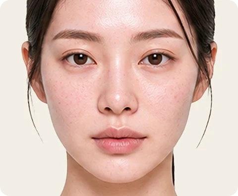 Ultherapy Prime — illustrative result at ระหว่างฉีด