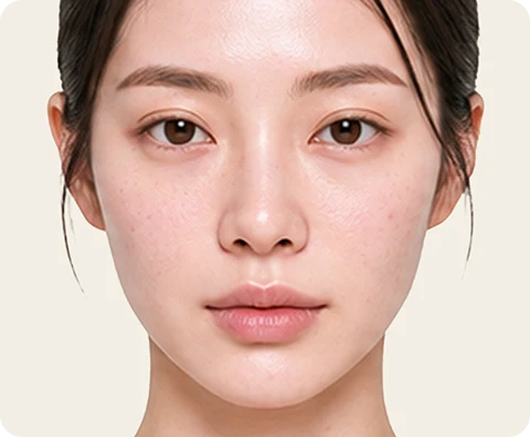 Ultherapy Prime — illustrative result at วันที่ 0