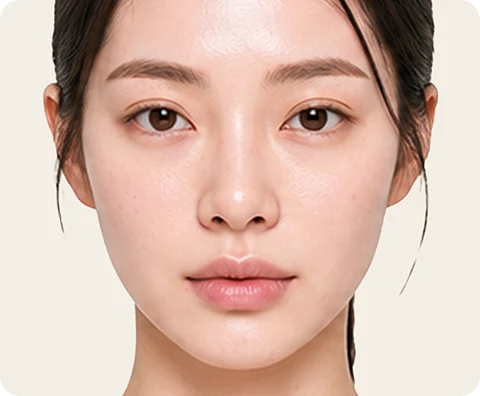 Ultherapy Prime — illustrative result at วันที่ 1–2