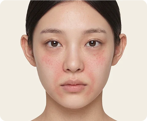 Ultherapy Prime — illustrative result at วันที่ 0–3