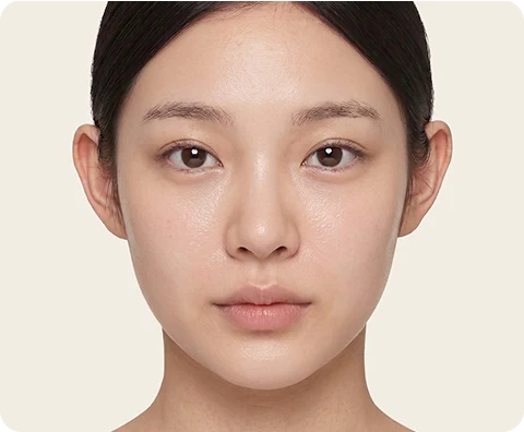 Ultherapy Prime — illustrative result at สัปดาห์ที่ 4–8
