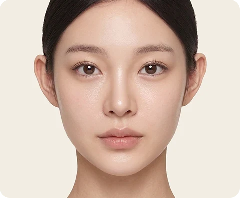 Ultherapy Prime — illustrative result at เดือนที่ 3–6