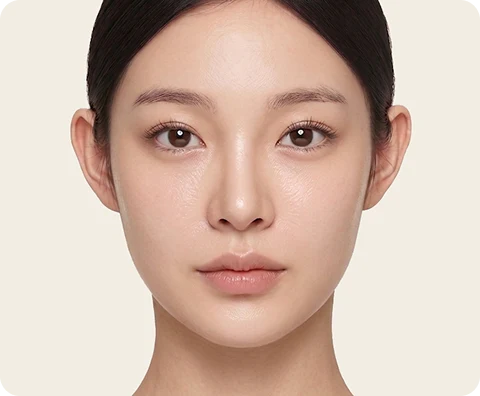 Ultherapy Prime — illustrative result at ~24 เดือน