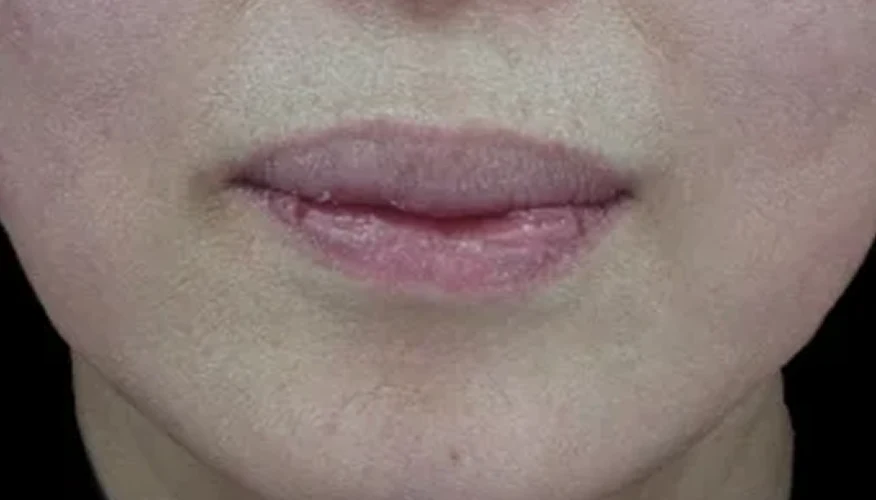 Thermage FLX — after