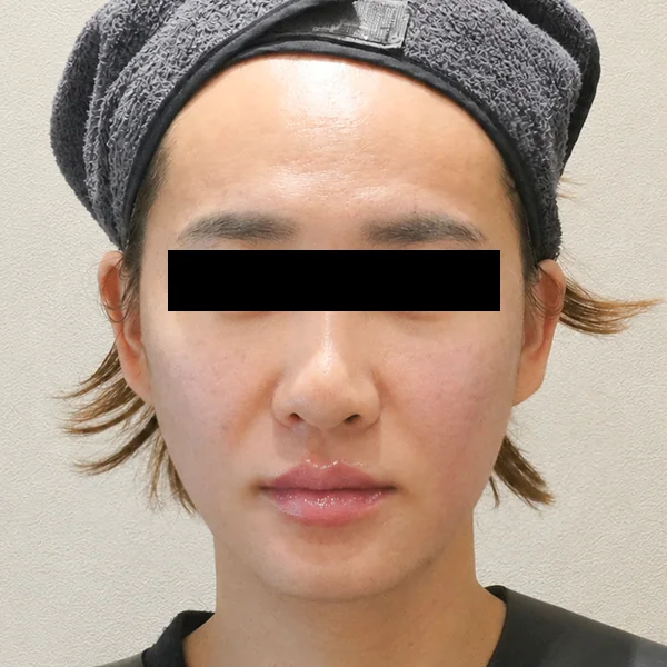 Thermage FLX — หลัง
