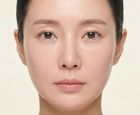 Thermage FLX — illustrative result at 3 Months