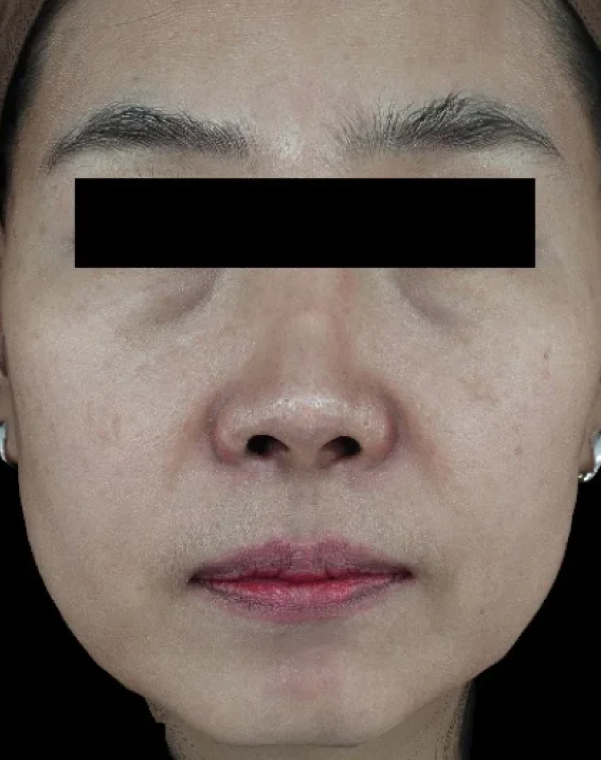 Ultherapy / ウルセラ — 施術前