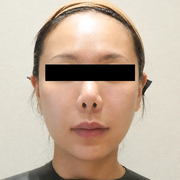 Ultherapy Prime: after