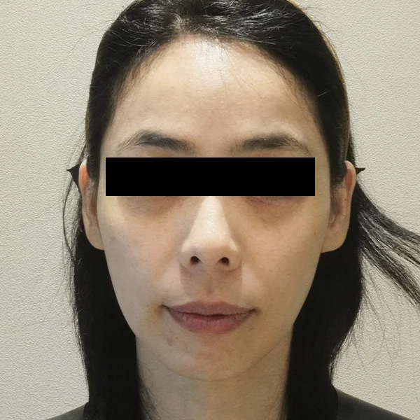 Ultherapy Prime — trước