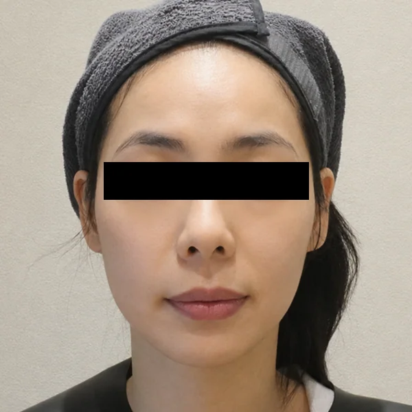 Ultherapy Prime（Ulthera System）: 治疗后