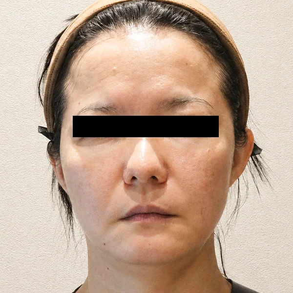 Ultherapy Prime: before