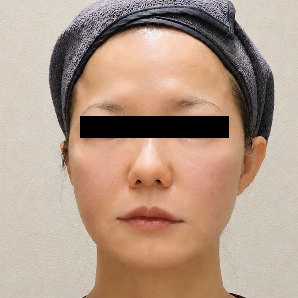 Ultherapy Prime（Ulthera System）: 治疗后