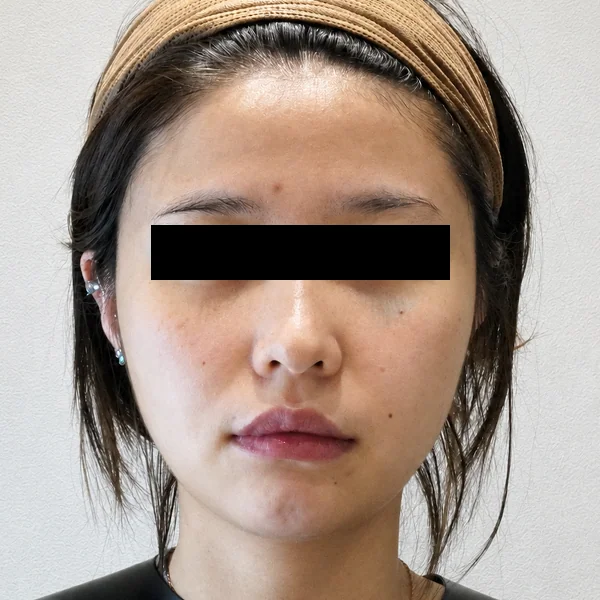 Ultherapy Prime（Ulthera System）: 治疗前
