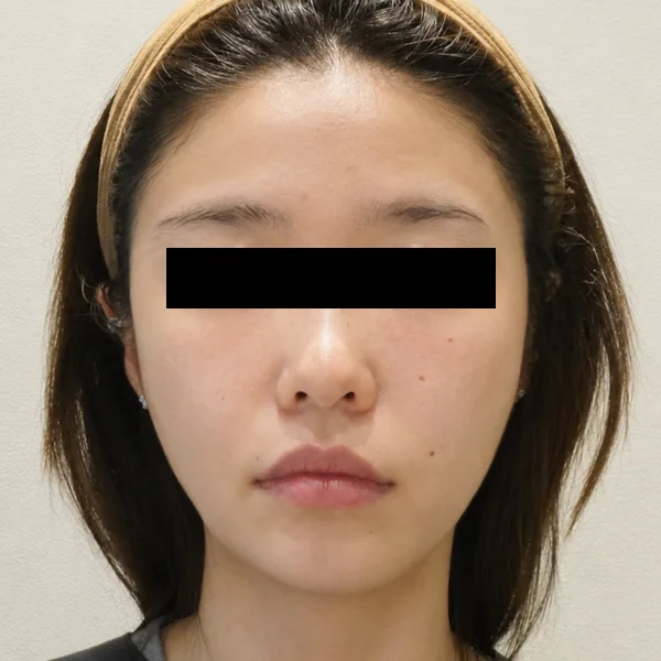 Ultherapy Prime（Ulthera System）: 治疗后