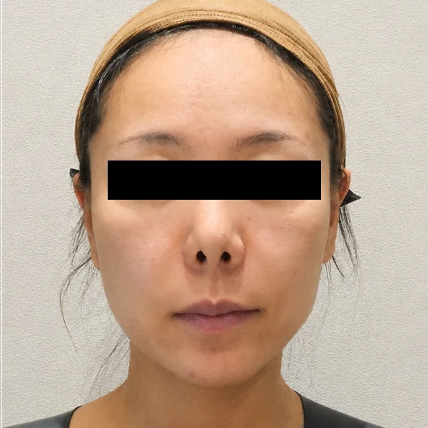Ultherapy Prime — trước