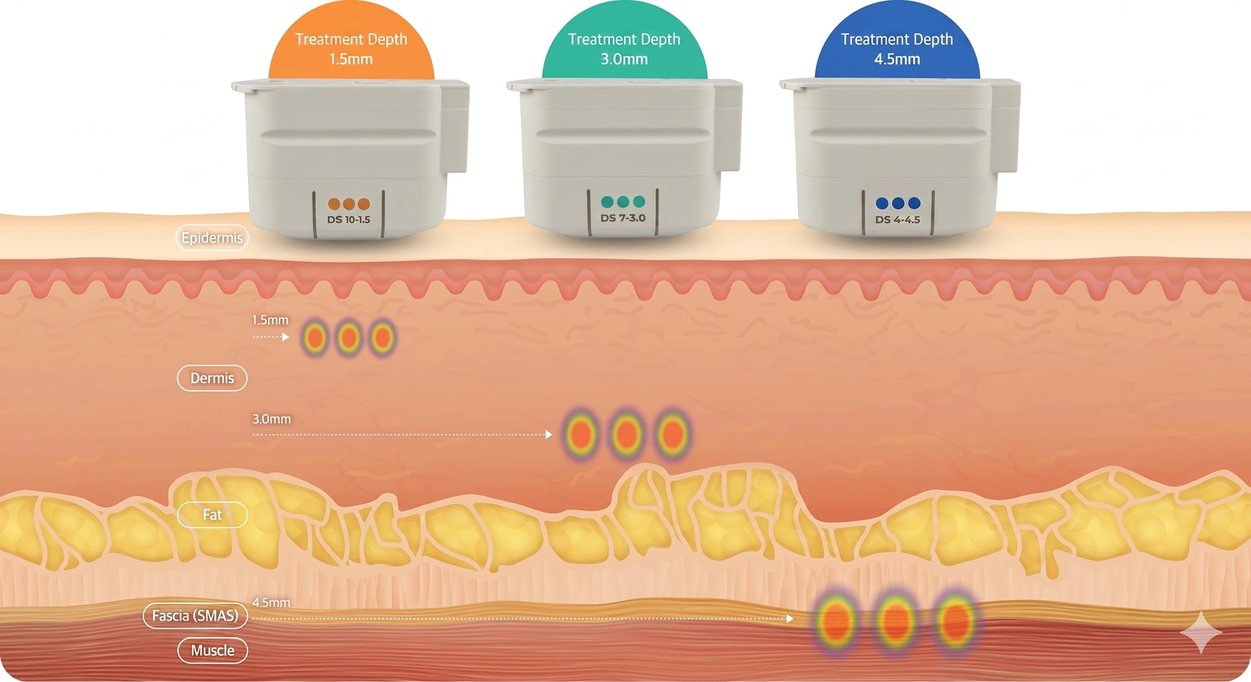 Ultherapy Prime transducer depths — 1.5 mm, 3.0 mm and 4.5 mm mapped across the epidermis, dermis, fat and SMAS layers