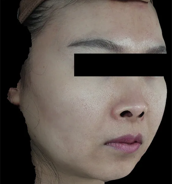 After — โปรแกรมรักษาสิว