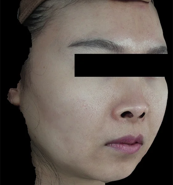 痘痘治疗方案 — 治疗后