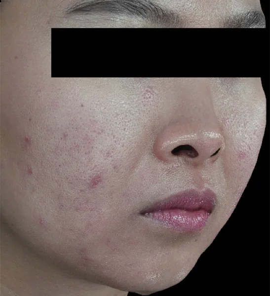 Before — โปรแกรมรักษาสิว