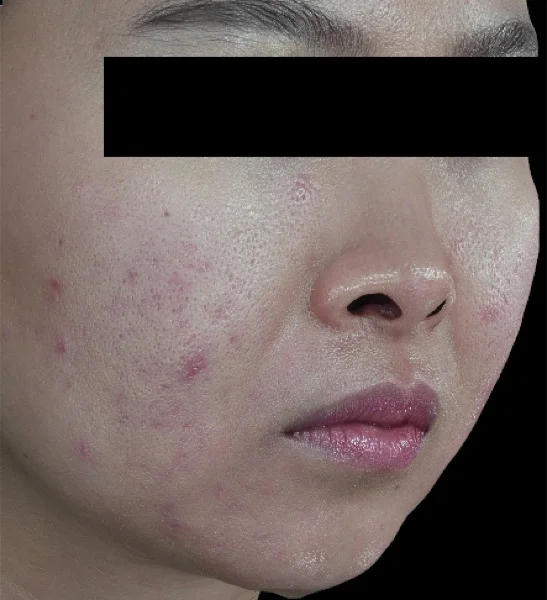 Before — Acne treatment program
