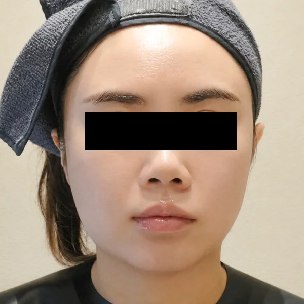 시술 후 — 보톡스 윤곽 (포텐자·스킨부스터 병행)