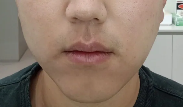 After — ปรับรูปหน้าด้วย Botox