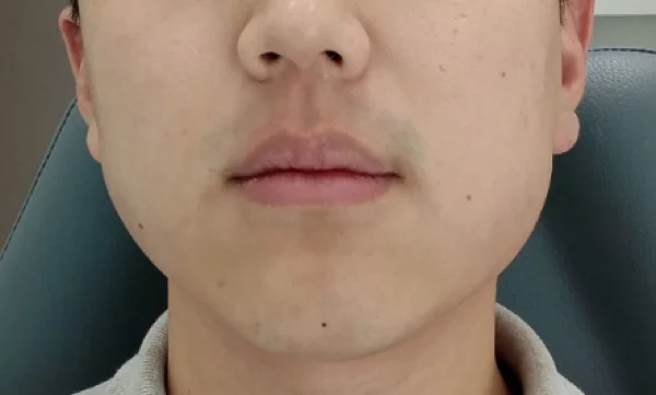 Before — Botox facial contouring