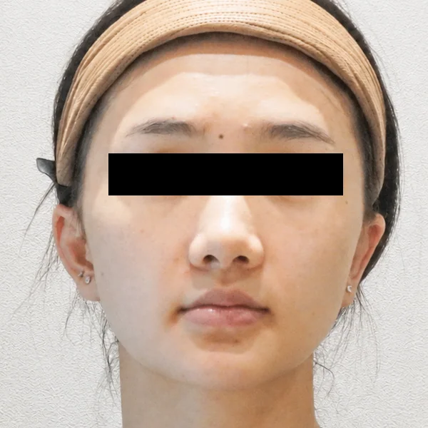 시술 전 — 복합 프로그램 (소프웨이브·엘라비에 RE2O)