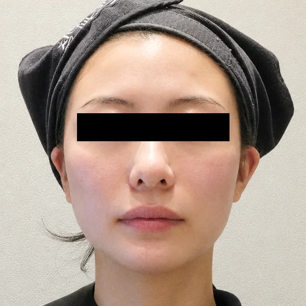 시술 후 — 턱 필러 (보톡스·스킨부스터 병행)